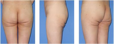 Difficulty of Severe Post-liposuction Infragluteal Deformity Correction With Autologous Fat Transplantation: A Case Report